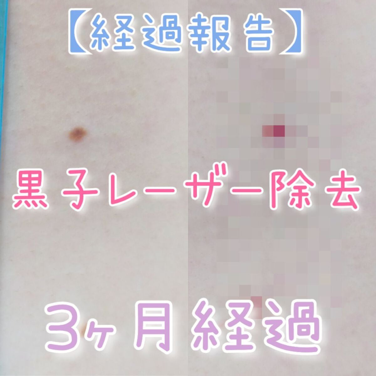 敏感肌な研究者💊あすか💊 on LIPS 「#ホクロをレーザーで除去したお話の経過報告です⚠️患部の写真が..」(1枚目)