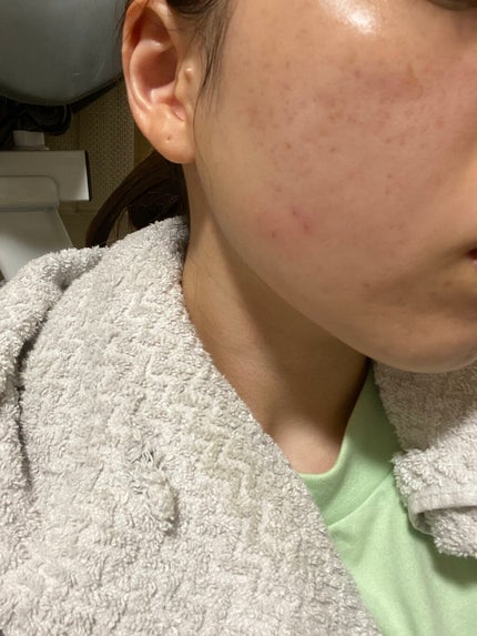 スキンピールバー ハイドロキノール/サンソリット/洗顔石鹸を使ったクチコミ(2枚目)