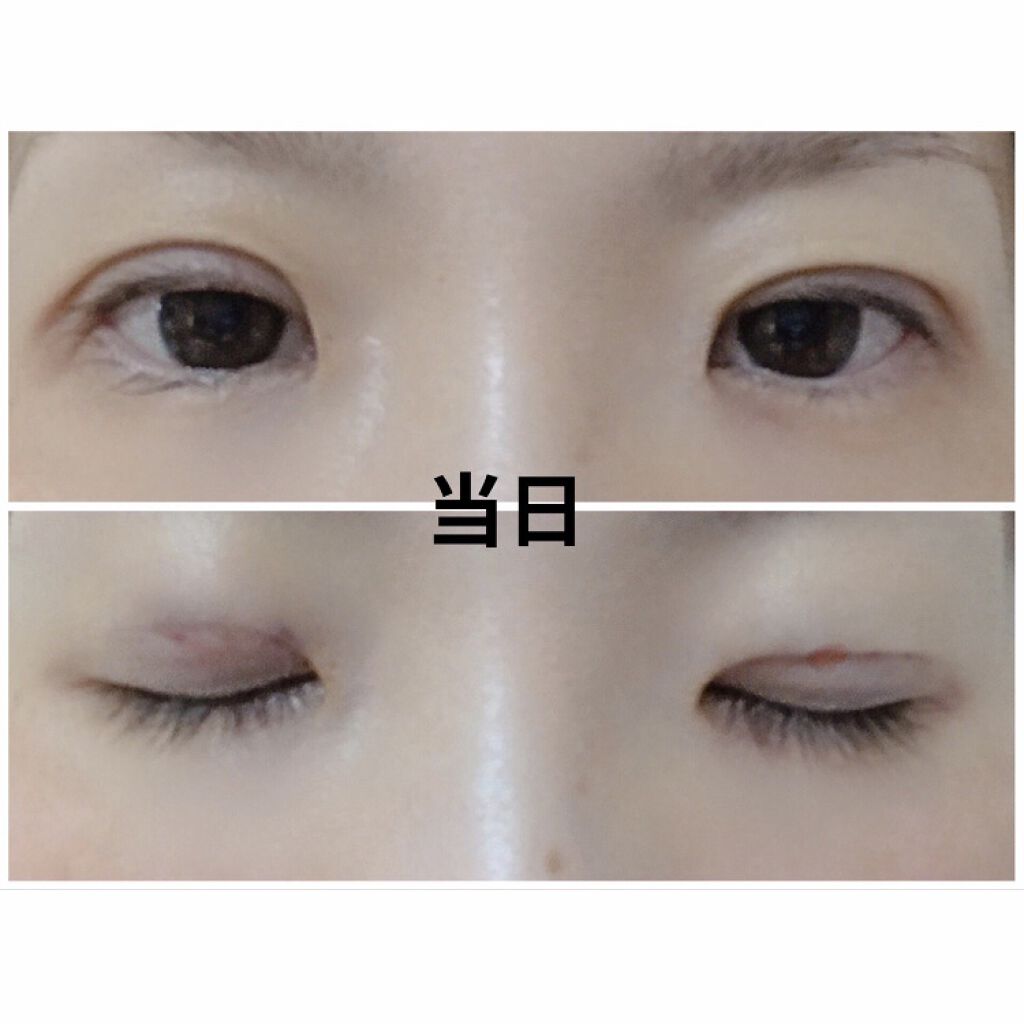 二重整形/その他を使ったクチコミ（2枚目）