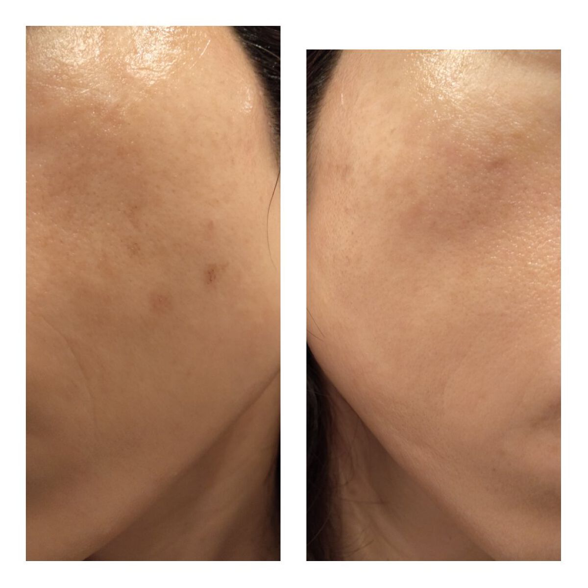 あにゃにゃ♡フォロバ100♡ on LIPS 「11/12に4回目のフォトシルクプラス(シミ取り)を受けてきま..」(7枚目)