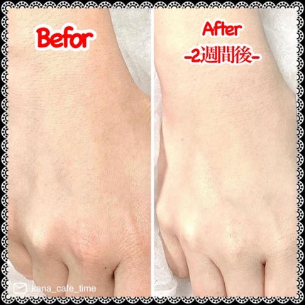 スキンピールバー ティートゥリー/サンソリット/洗顔石鹸を使ったクチコミ(6枚目)