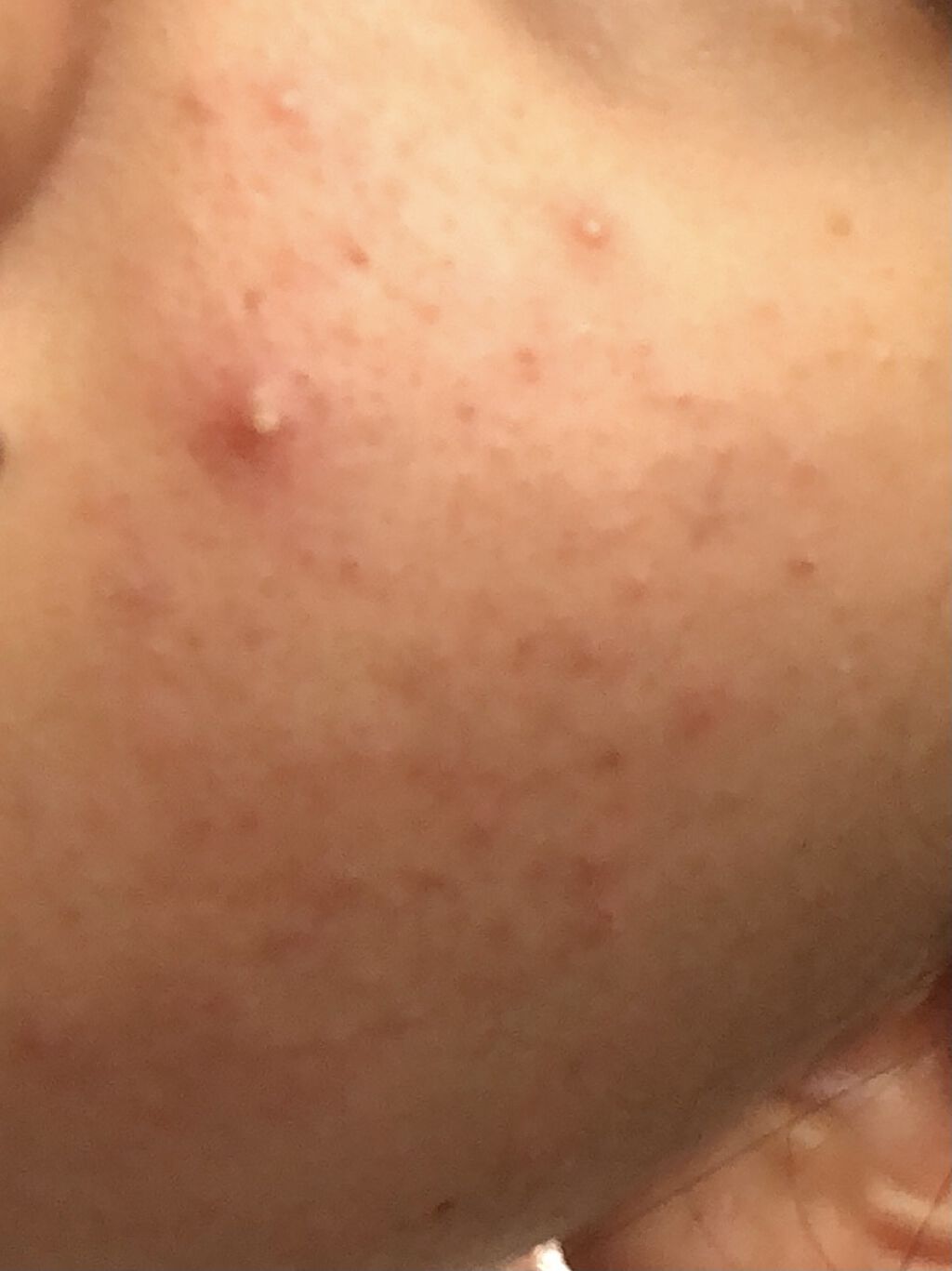 薬用しみ対策 美白化粧水 しっとりタイプ/メラノCC/化粧水を使ったクチコミ（2枚目）