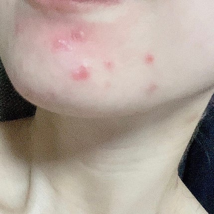 マジックティーツリーオイル/ブラン/フェイスオイルを使ったクチコミ(3枚目)