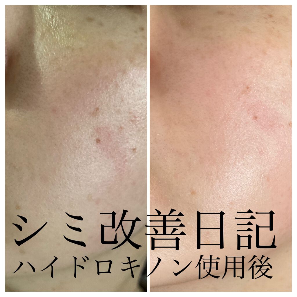 薬用 しみ 集中対策 美容液/メラノCC/美容液を使ったクチコミ（1枚目）