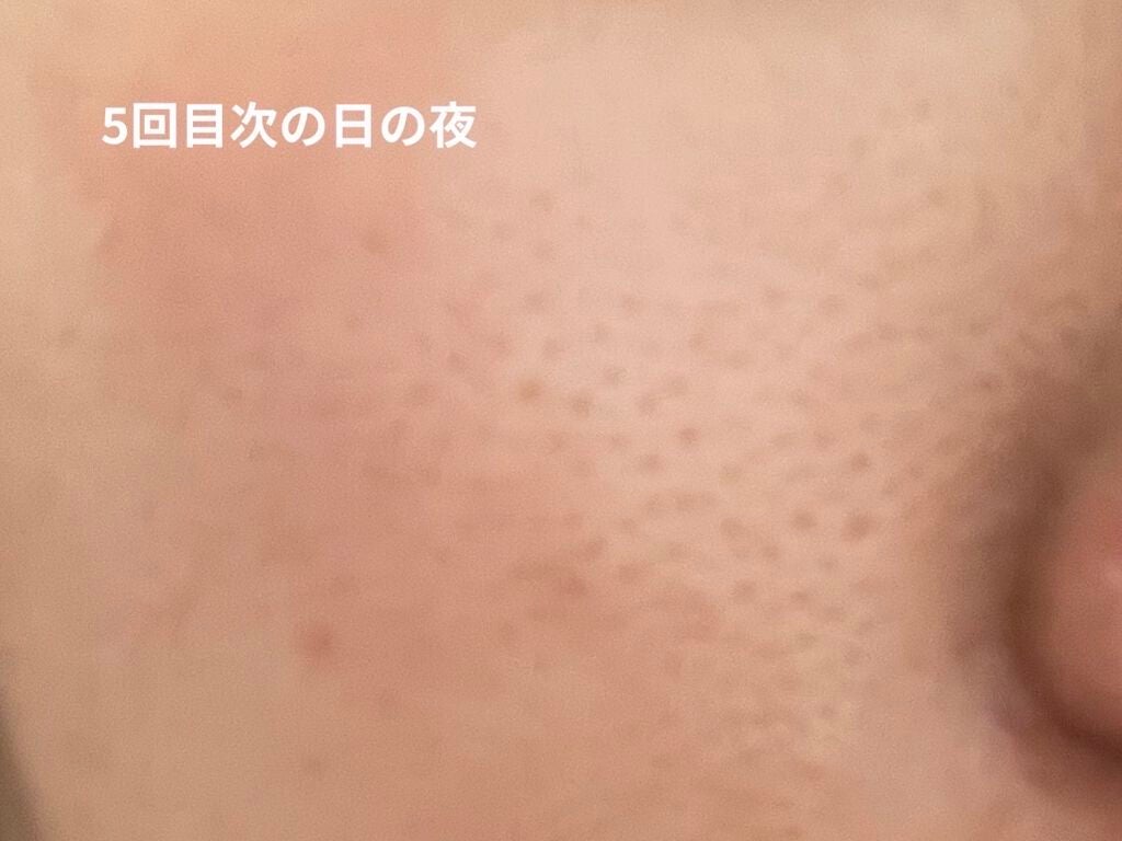 レチノールA 1% アドバンスドリバイタリゼーションクリーム/Life-flo/フェイスクリームを使ったクチコミ(4枚目)