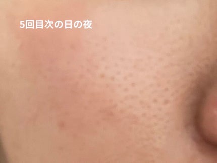 レチノールA 1% アドバンスドリバイタリゼーションクリーム/Life-flo/フェイスクリームを使ったクチコミ(4枚目)