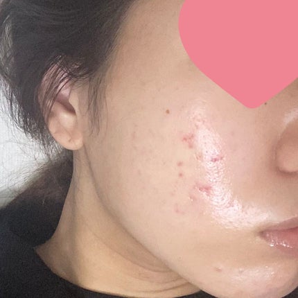 レチノールA 1% アドバンスドリバイタリゼーションクリーム/Life-flo/フェイスクリームを使ったクチコミ(2枚目)