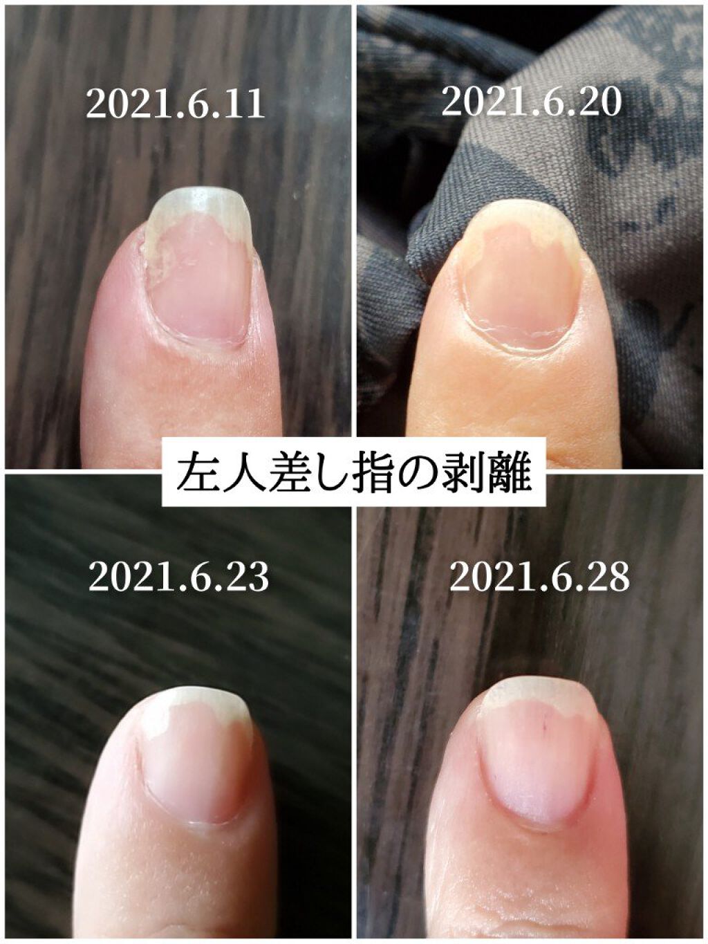 ネイルベッドオイル アンドネイルの口コミ 爪甲剥離症の育爪記録以前の投稿はこちらに By かぴめろん 気力ダウン 乾燥肌 40代後半 Lips