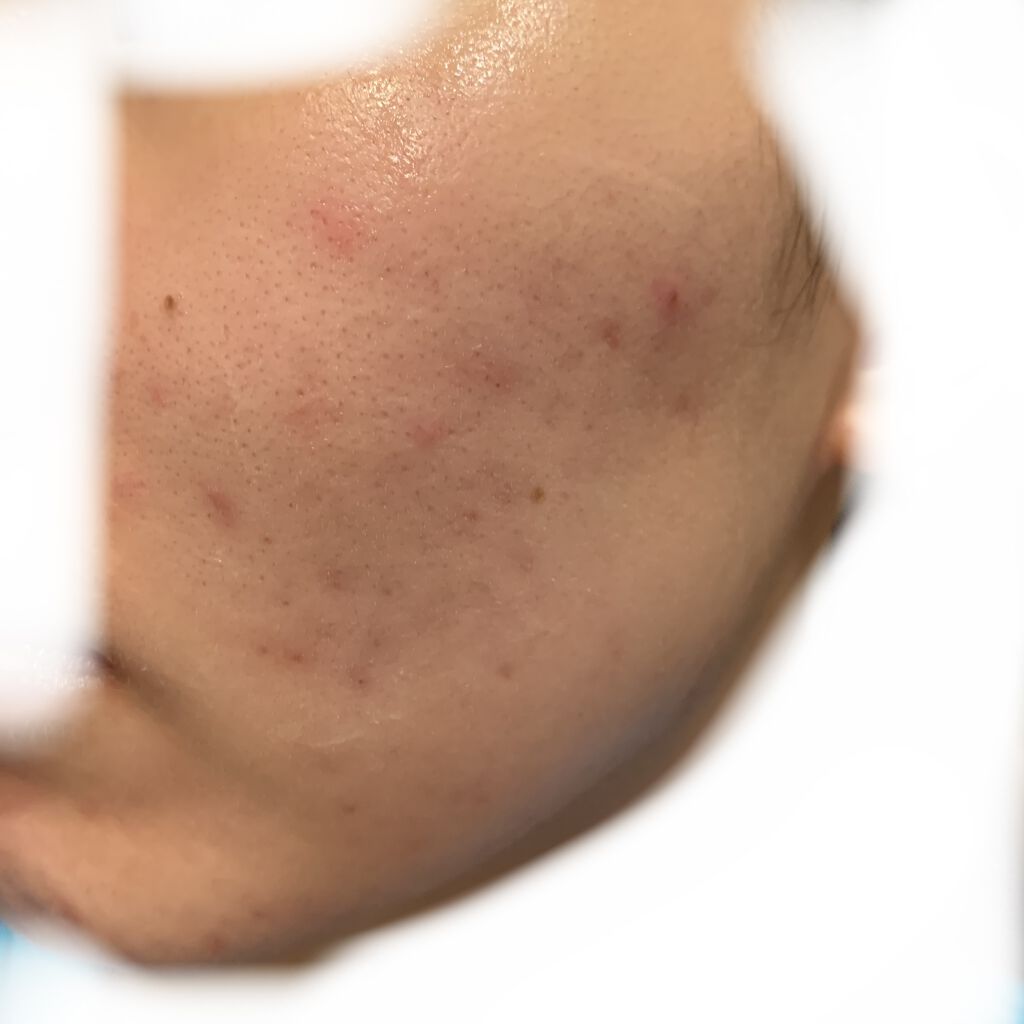 肌美精 大人のニキビ対策 薬用ホワイトクリア洗顔料のクチコミ「新しいニキビはあまり出てないよ

ちなみに洗顔は肌美精

このシリーズの化粧水、美白クリームも.....」（1枚目）