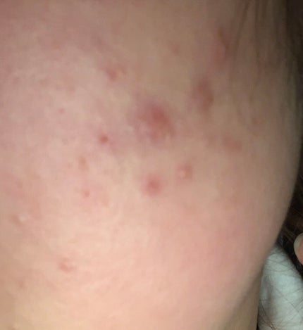 オードムーゲ 薬用ローション(ふきとり化粧水)/オードムーゲ/拭き取り化粧水を使ったクチコミ(2枚目)