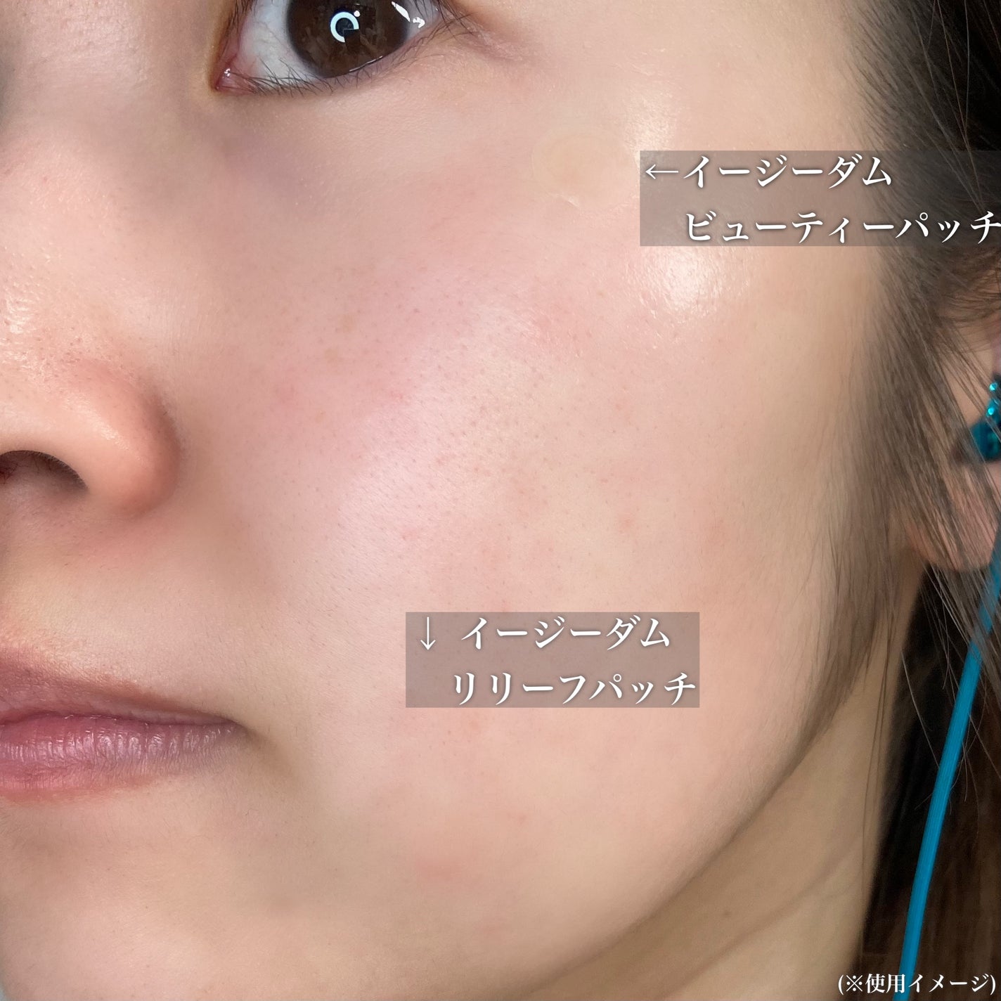 ビューティー スポットパッチ/イージーダムビューティー/にきびパッチを使ったクチコミ(8枚目)