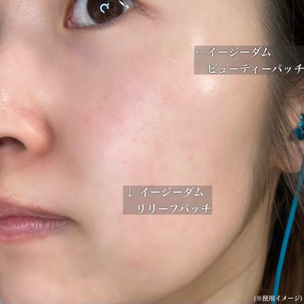 ビューティー スポットパッチ/イージーダムビューティー/にきびパッチを使ったクチコミ(8枚目)