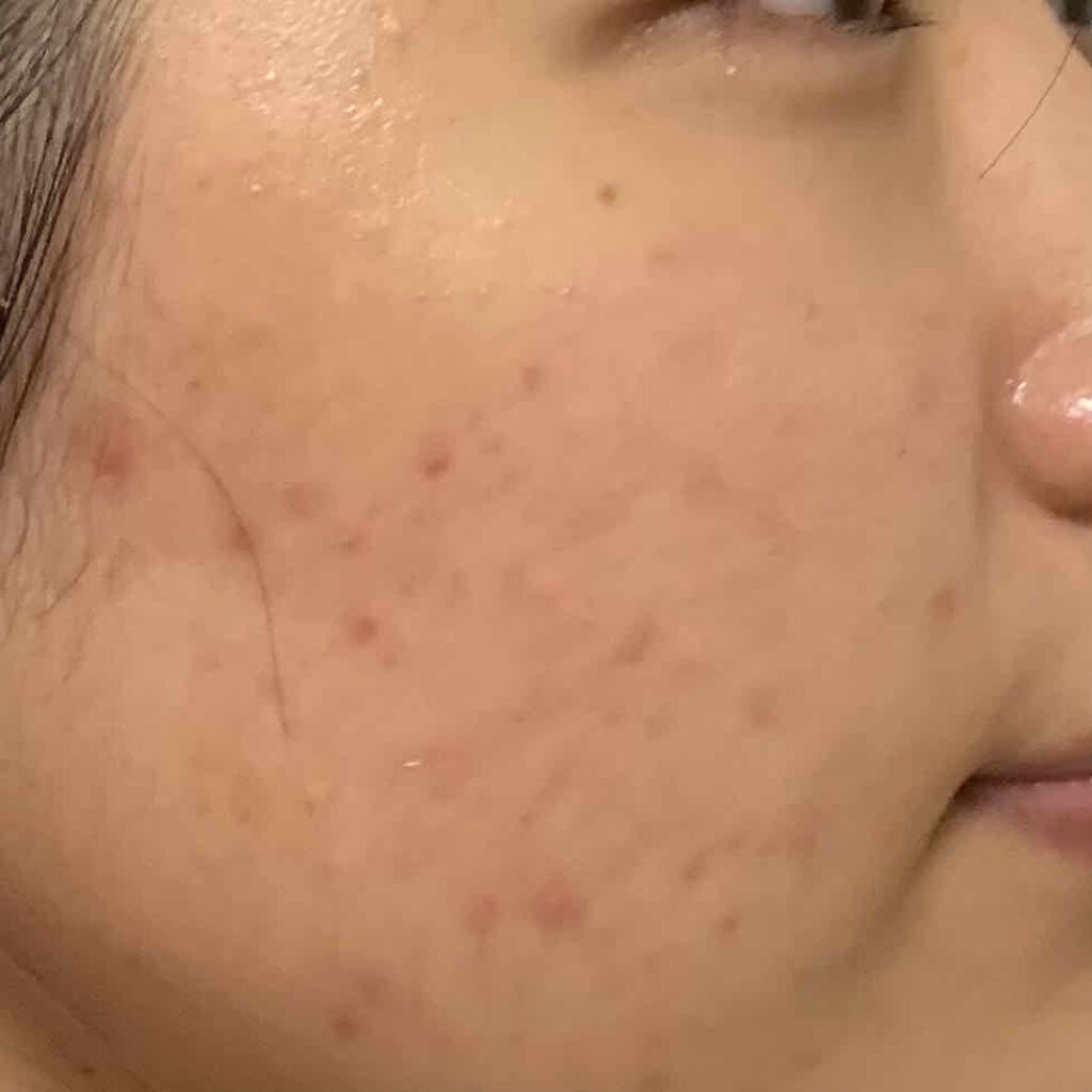 薬用 クリアローション M(しっとりタイプ)/オルビス/化粧水を使ったクチコミ（2枚目）