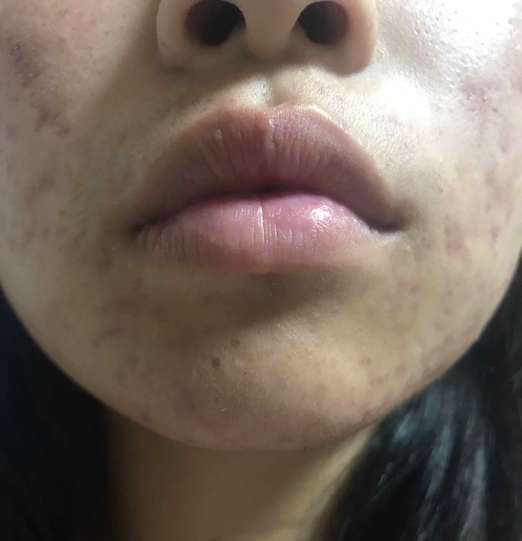 ポム on LIPS 「#みんなに質問#最近のスキンケア#ニキビ跡#ニキビケア#ニキビ..」(4枚目)