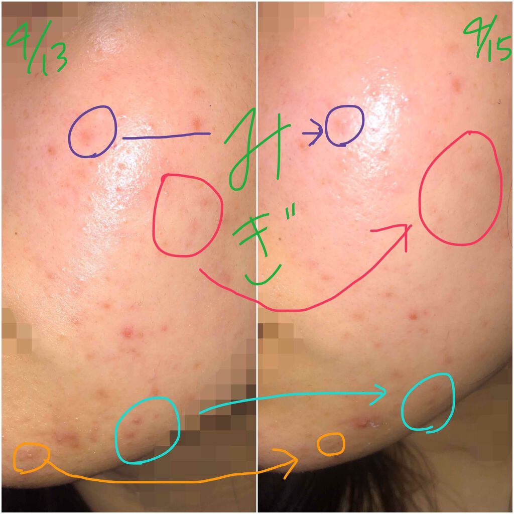 薬用 しみ 集中対策 美容液/メラノCC/美容液を使ったクチコミ(3枚目)