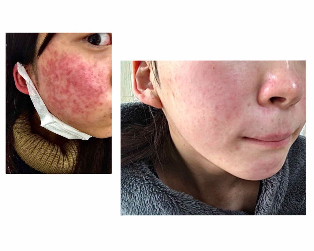 バイオイル/バイオイル/フェイスオイルを使ったクチコミ(2枚目)