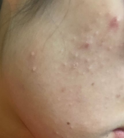 シカレチA クリーム0.05/VT/フェイスクリームを使ったクチコミ(3枚目)