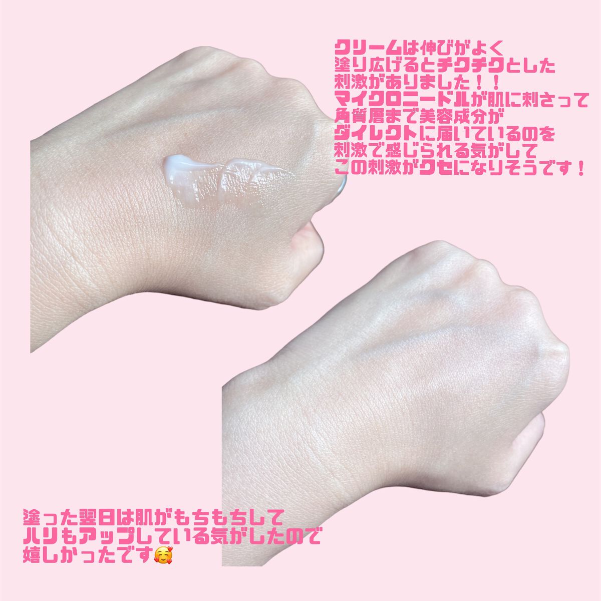 メディリフト ニードルリフトクリーム/YA-MAN TOKYO JAPAN/フェイスクリームを使ったクチコミ（3枚目）