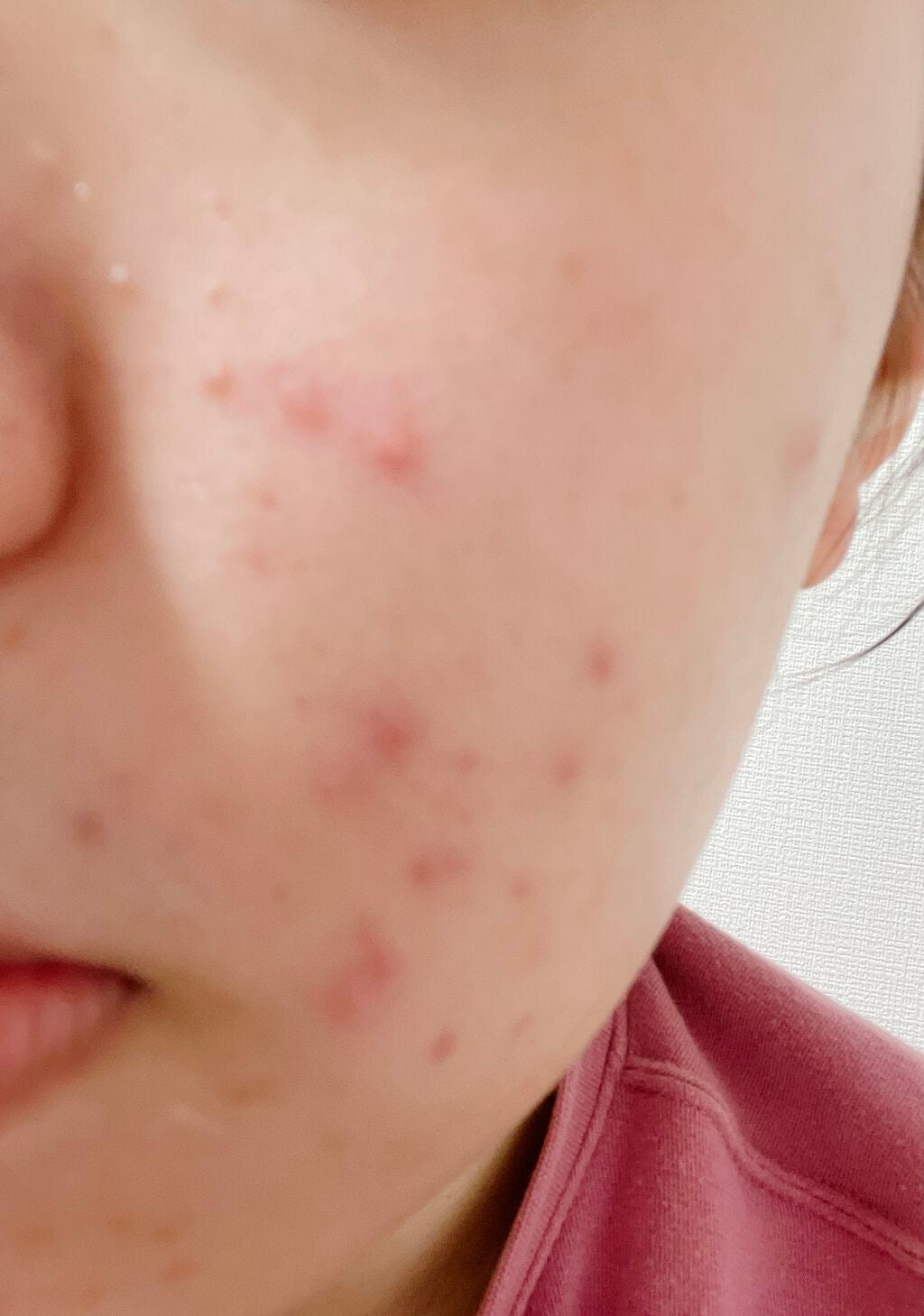 ニキビ日記 on LIPS 「⚠︎閲覧注意マスクをつけるようになってから赤ニキビができるよう..」(1枚目)
