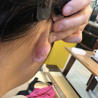 ポリ 医薬品 佐藤製薬の使い方を徹底解説 ピアスですぐに膿む人にオススメの塗り薬を紹 By わかめ アトピー肌 10代後半 Lips