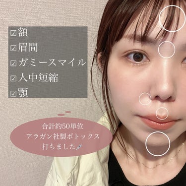 mana🫧プチプラで楽しむ大人の美容/コスメ on LIPS 「ボトックス打ってきたよ//念願のボトックス打ってきたよ〜💉額の..」（2枚目）