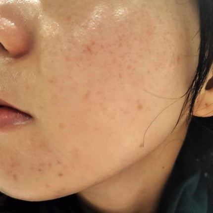 AHA 30% + BHA 2% Peeling Solution/The Ordinary/ピーリングを使ったクチコミ(2枚目)