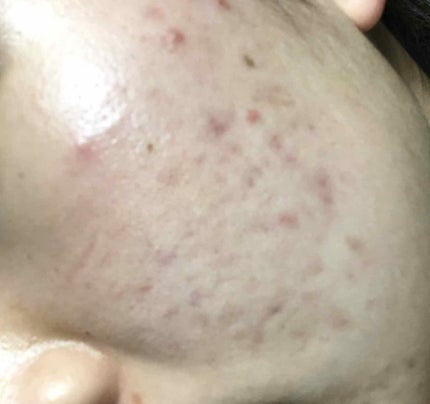 ょ on LIPS 「2枚目の写真2019年の3月のもの小学生から悩んでたニキビがニ..」(4枚目)