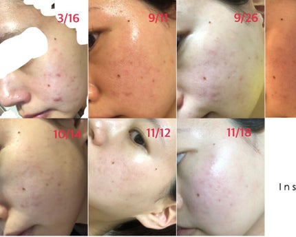 ぷん。 on LIPS 「9月25日に初めて皮膚科に行ってお薬を貰いました。べピオゲルと..」(1枚目)