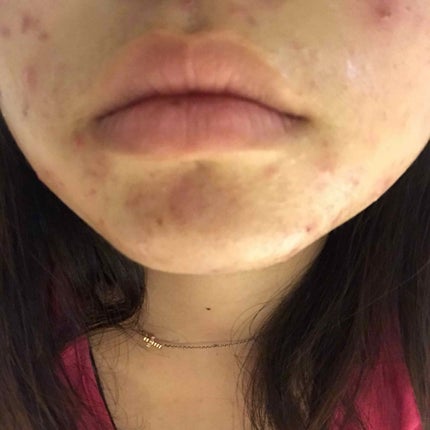 ポム on LIPS 「レーザー治療をしたので明日からまたひどくなるなぁ😂😂根気強く頑..」(4枚目)