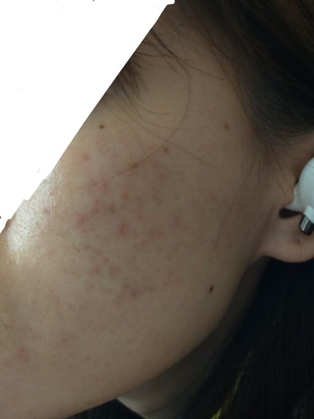 薬用 しみ 集中対策 美容液/メラノCC/美容液を使ったクチコミ(1枚目)