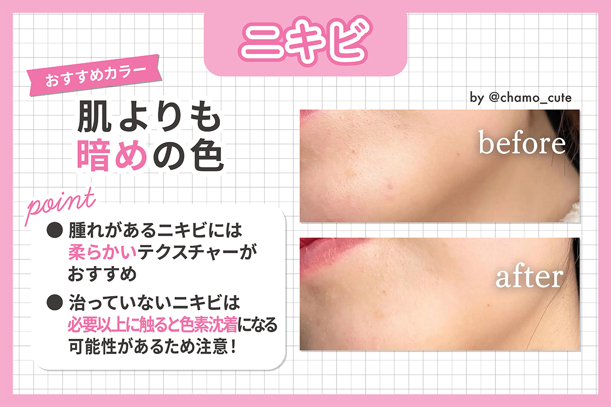 ニキビのカバーにおすすめカラーは、肌よりも暗めの色。腫れがあるニキビには柔らかいテクスチャーがおすすめ。治っていないニキビは、必要以上に触ると色素沈着になる可能性があるため注意！