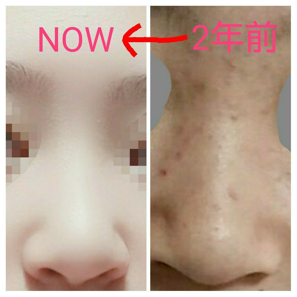 ベピオゲル/マルホ株式会社/その他を使ったクチコミ（1枚目）