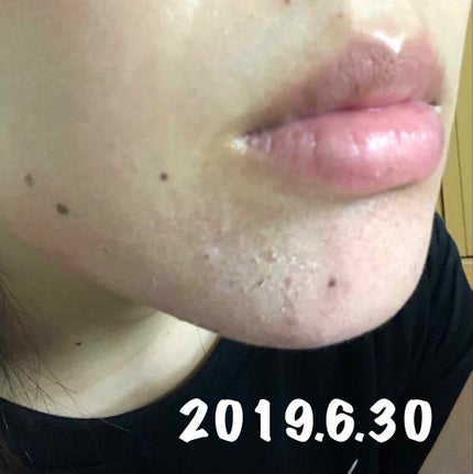 十味敗毒湯 ジュウミハイドクトウ(医薬品)/クラシエ薬品/その他を使ったクチコミ(3枚目)