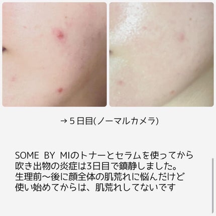 スターターキット/SOME BY MI/トライアルキットを使ったクチコミ(3枚目)