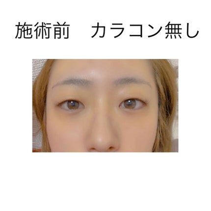 あんにんどーふ。 on LIPS 「🔥🤍🔥🤍🔥🤍🔥🤍🔥🤍私事ですが、【二重埋没法】をしてきたので記..」(2枚目)