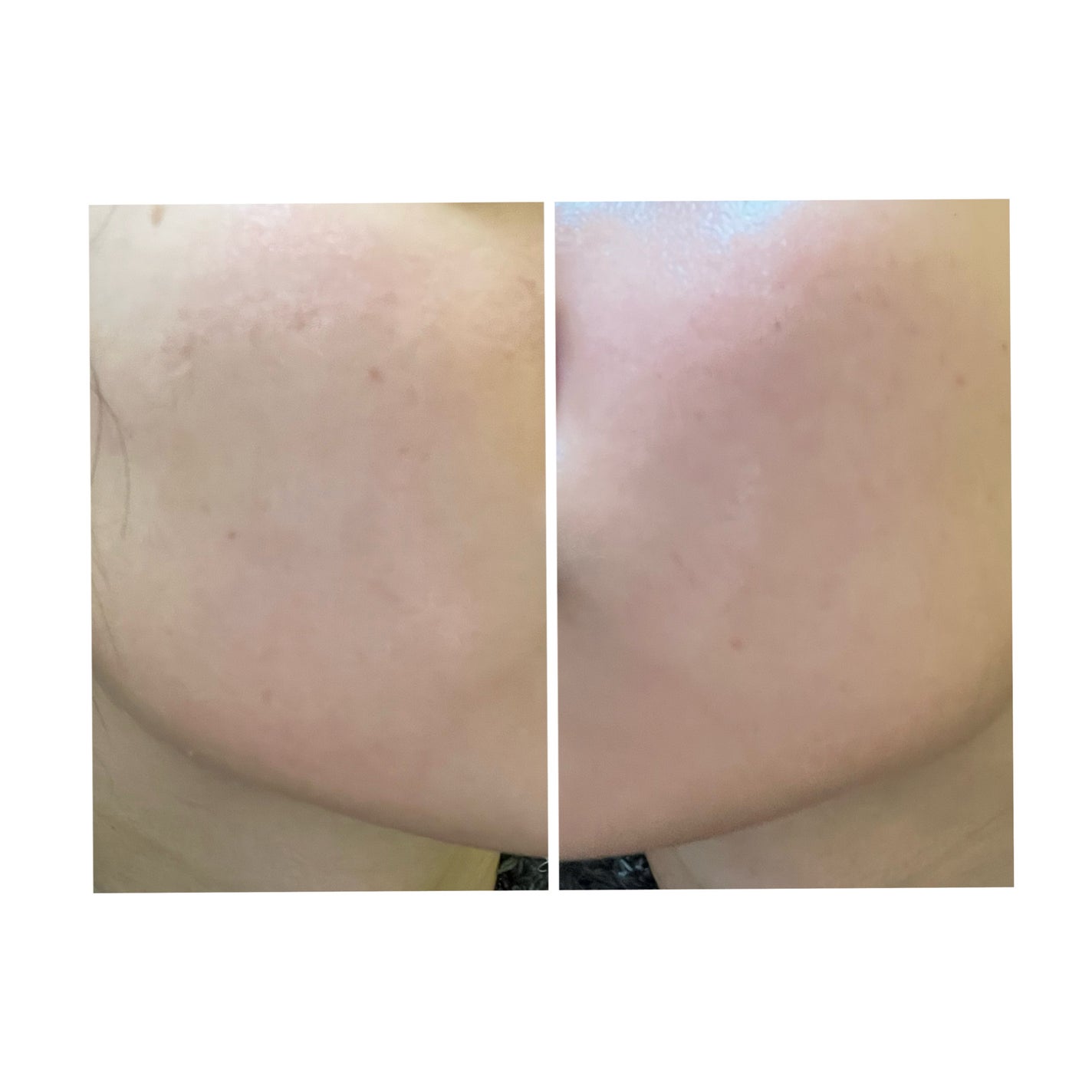 ぽむ on LIPS 「2023.9.13皮膚科に受診 エピデュオとヘパリン処方1枚目..」(2枚目)