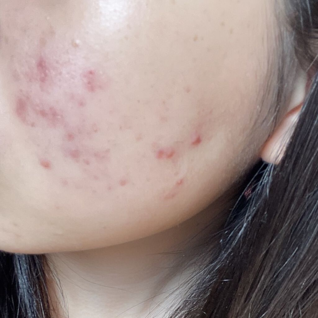 ヒルマイルドクリーム(医薬品)/健栄製薬/その他を使ったクチコミ（2枚目）