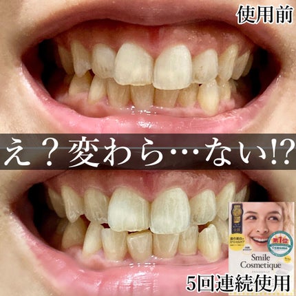 プレミアム ティースホワイトパック/Smile Cosmetique/その他オーラルケアを使ったクチコミ(2枚目)