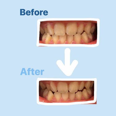 垢抜けしたくてメイクや髪染め以外に出来ることがしたくて調べました！
『歯を白くする』ことで垢抜けへの第一歩になるんじゃないかな！と思います

何がいいんだろうと思い、LIPSで色々調べてみると、歯に直接貼る3Dシートのようなものがあり、そういえばこれ前にななこちゃんがYouTubeで紹介してたやつだ！と思いこれ欲しい！と思いましたが高い。効果はありそうだけど、学生にはちょっと手を出しづらい値段^^;  お金を貯めて買おうと思いました。。。💸

そこで！！！！
このミュゼの速攻美白を見つけました👏🏻👏🏻👏🏻👏🏻👏🏻
値段も500円ちょっとだしこれなら買えると思い私はマツキヨでマツキヨのクーポンを使い495円でゲットしました！(マツキヨ信者
グレープフルーツがよかったけどこのミントの味しか置いていなかったです😅







いざ！！！！
取り出すとスポンジが濡れていて、百均とかにある水に濡らして床の汚れとかを落とす激落ちくん⁉️に似てました^_^
ミント味でしたが歯磨き粉のようにスースーする感じではなくそんなに味？はしませんでした^ ^
ゴシゴシやっているとだんだんと小さくなっていきよだれも出てきてもう限界！となり6分で終了〜


んんん〜うわめっちゃ白くなった〜とかじゃなくて、うーーーーん？ん、、、白くなった？かな、？！
くらいです笑笑笑笑
ほんのほんのほ〜んの気持ち程度白くなりましたね笑


まだ1回しかやっていないので、これを続ければ白くなっていくのかな？？？という感じです。








次はお金を貯めて3Dシート買います❗️
#はじめての投稿の画像 その2
