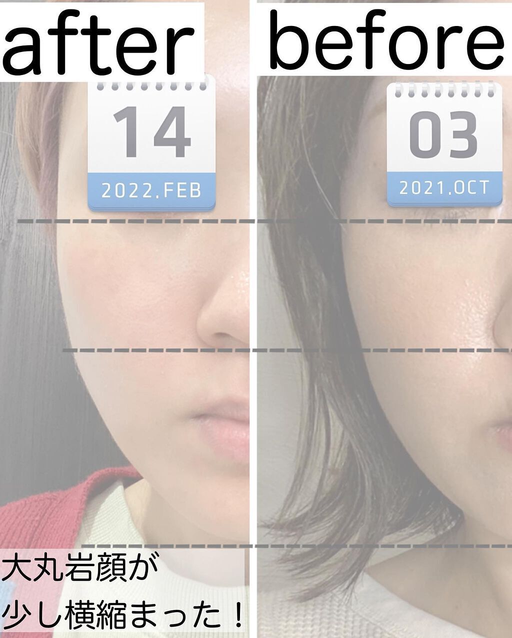 りっちゃん on LIPS 「やって良かった美容医療〜糸リフト編〜/年齢や昨今のマスク😷生..」(3枚目)