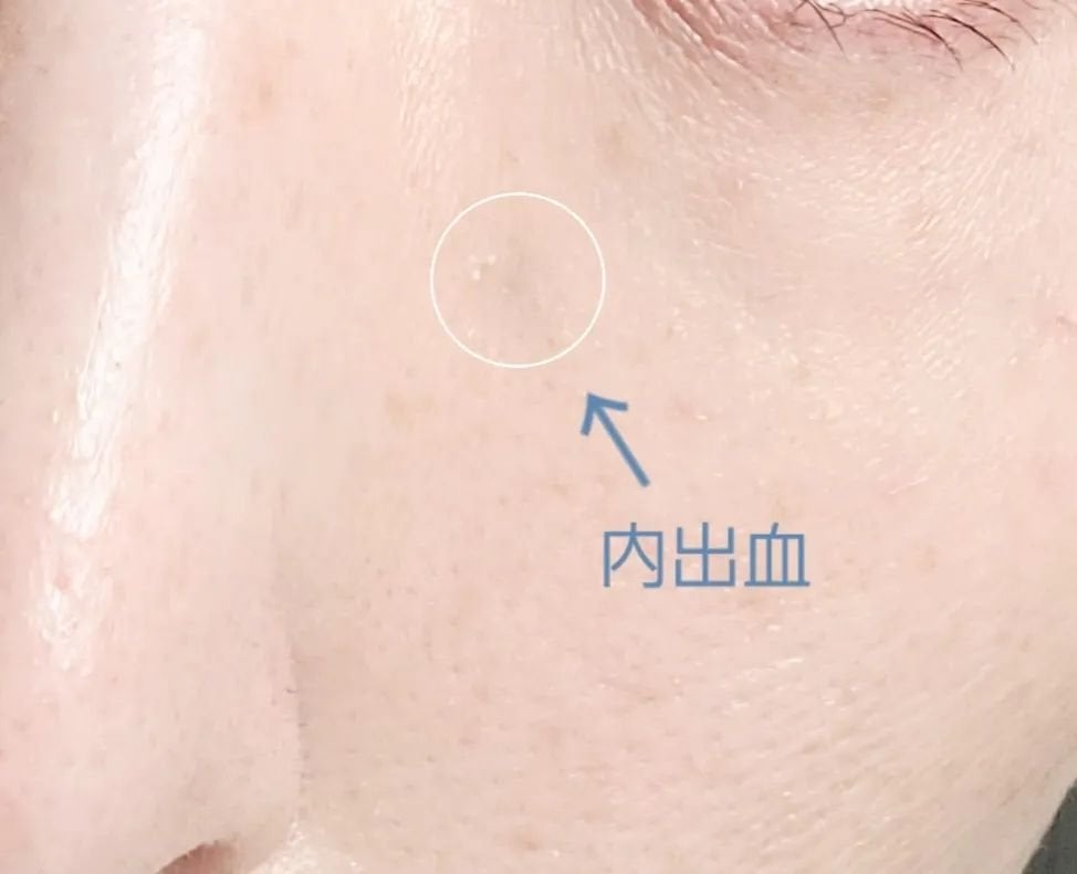 ちょこ on LIPS 「アラフィフの目元事情・・・鏡を覗く度に落ち込むものです🪞😞..」(2枚目)