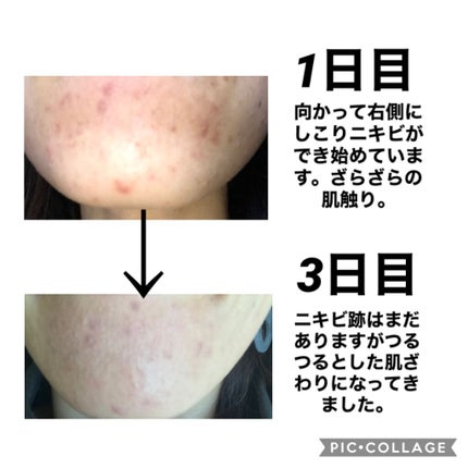 エピデュオゲル/マルホ株式会社/その他を使ったクチコミ(2枚目)