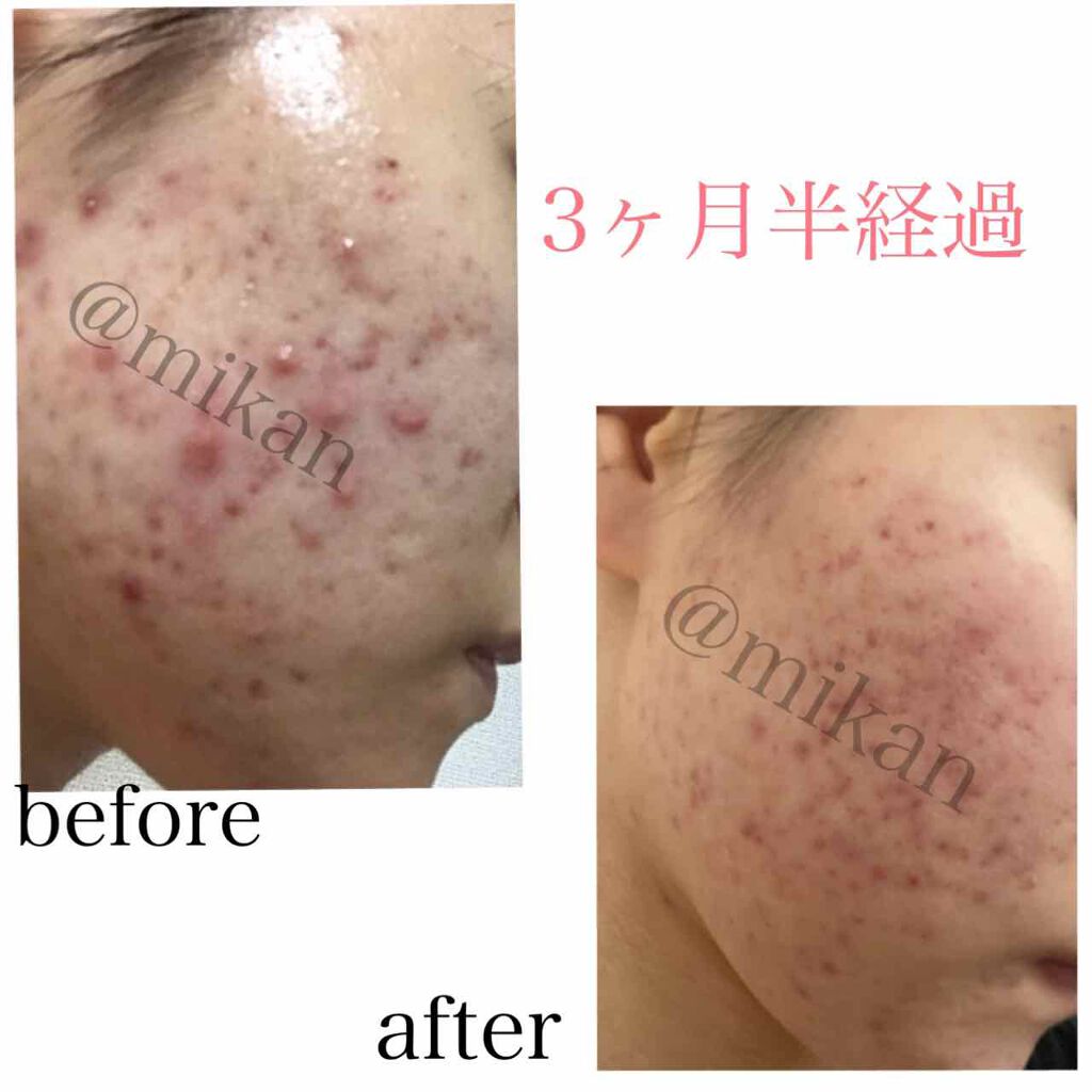 モイスチャークリーム2/エンビロン/フェイスクリームを使ったクチコミ(1枚目)