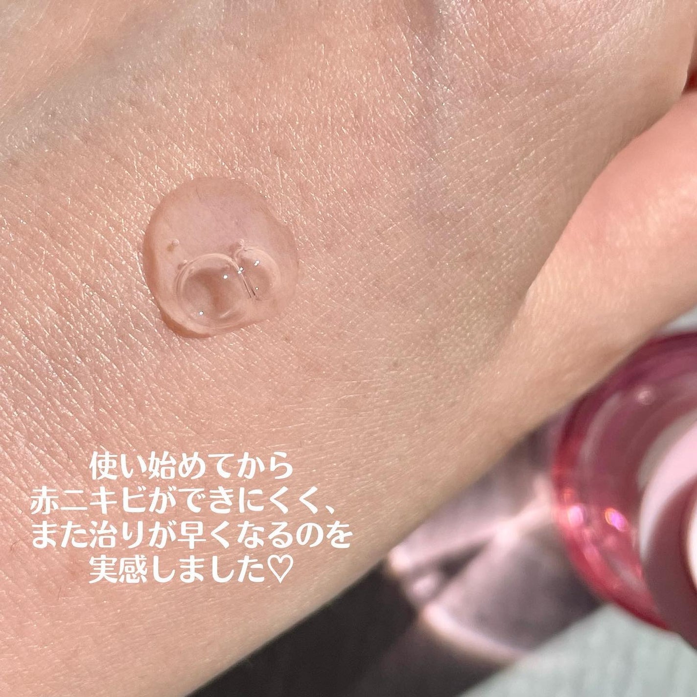 ピンクティーツリーシナジーセラム/APLIN/美容液を使ったクチコミ(4枚目)