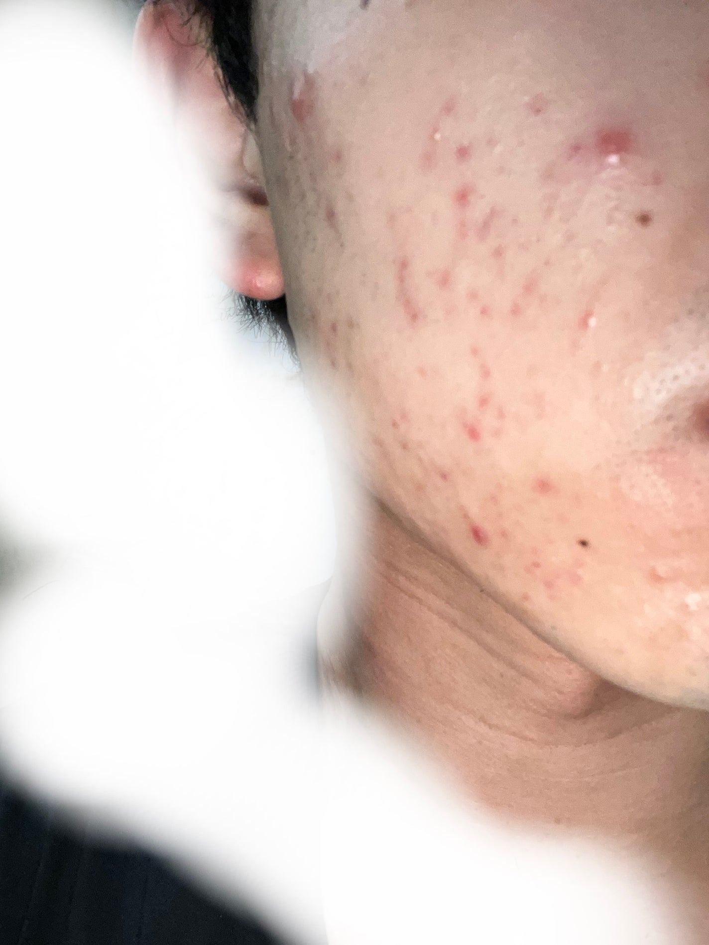 ロゼット洗顔パスタ アクネクリア/ロゼット/洗顔フォームを使ったクチコミ(2枚目)