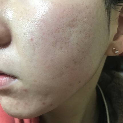 ティーツリーケア ソリューション エッセンシャルマスクEX/MEDIHEAL/シートマスク・パックを使ったクチコミ(2枚目)