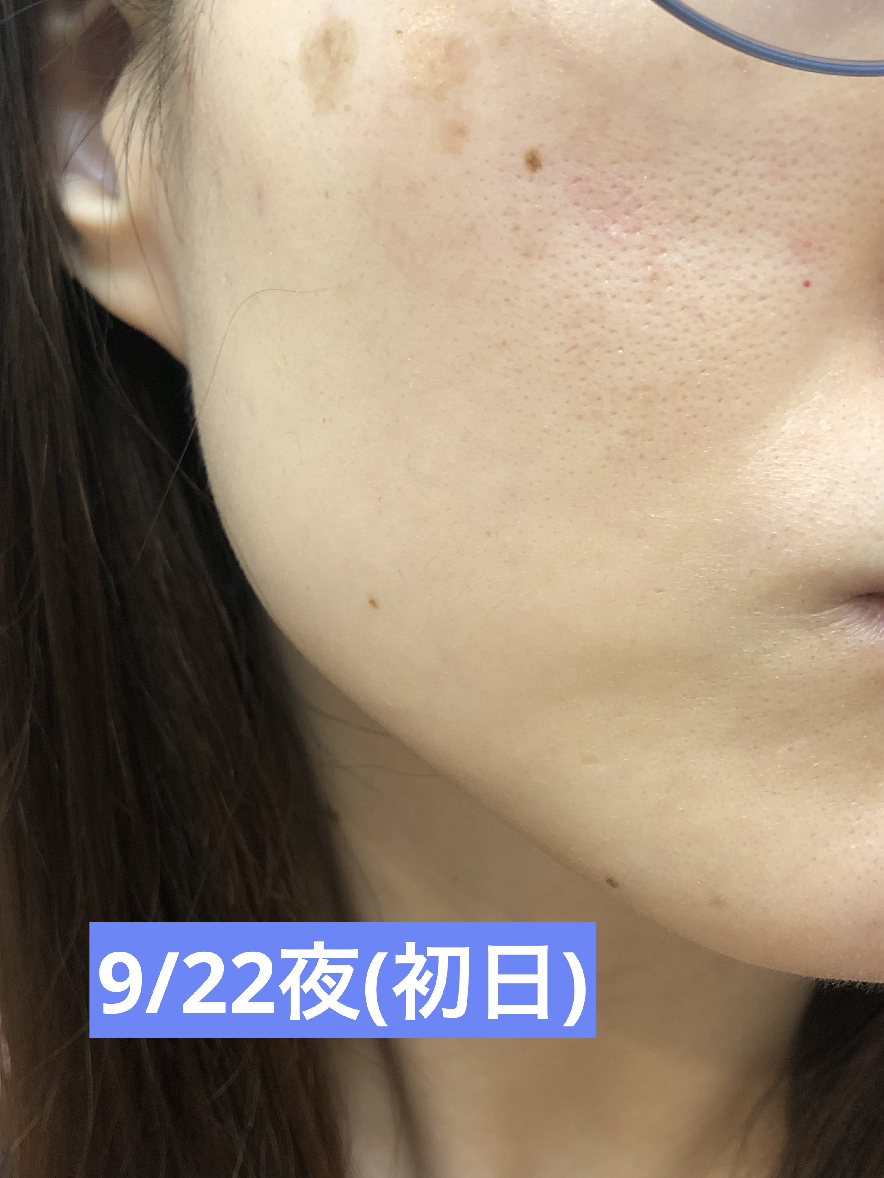 スキンライトセラピーII/Makeon/美顔器・マッサージを使ったクチコミ（2枚目）