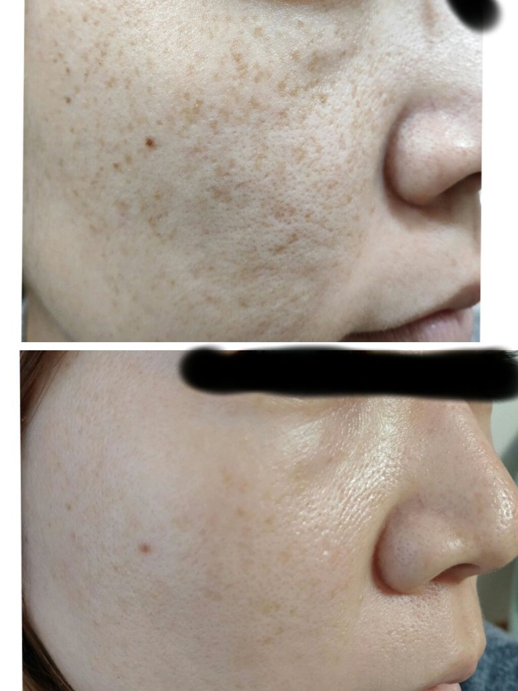 レチノールA 1% アドバンスドリバイタリゼーションクリーム/Life-flo/フェイスクリームを使ったクチコミ(1枚目)