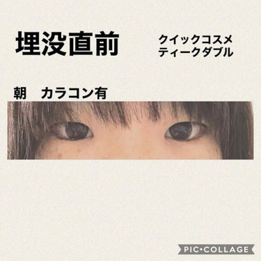 ぬこた on LIPS 「二重整形してきます！年末年始の休みを活用して埋没してきます。湘..」（2枚目）