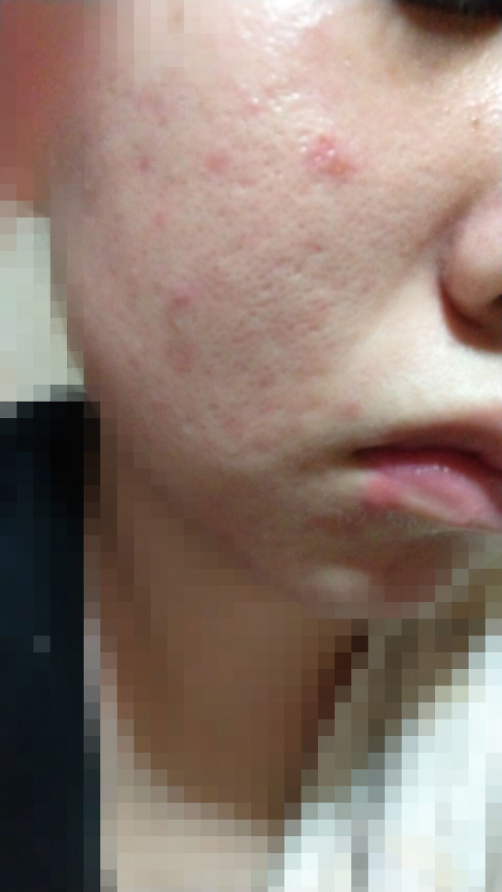 オロナインH軟膏 (医薬品)/オロナイン/その他を使ったクチコミ(4枚目)